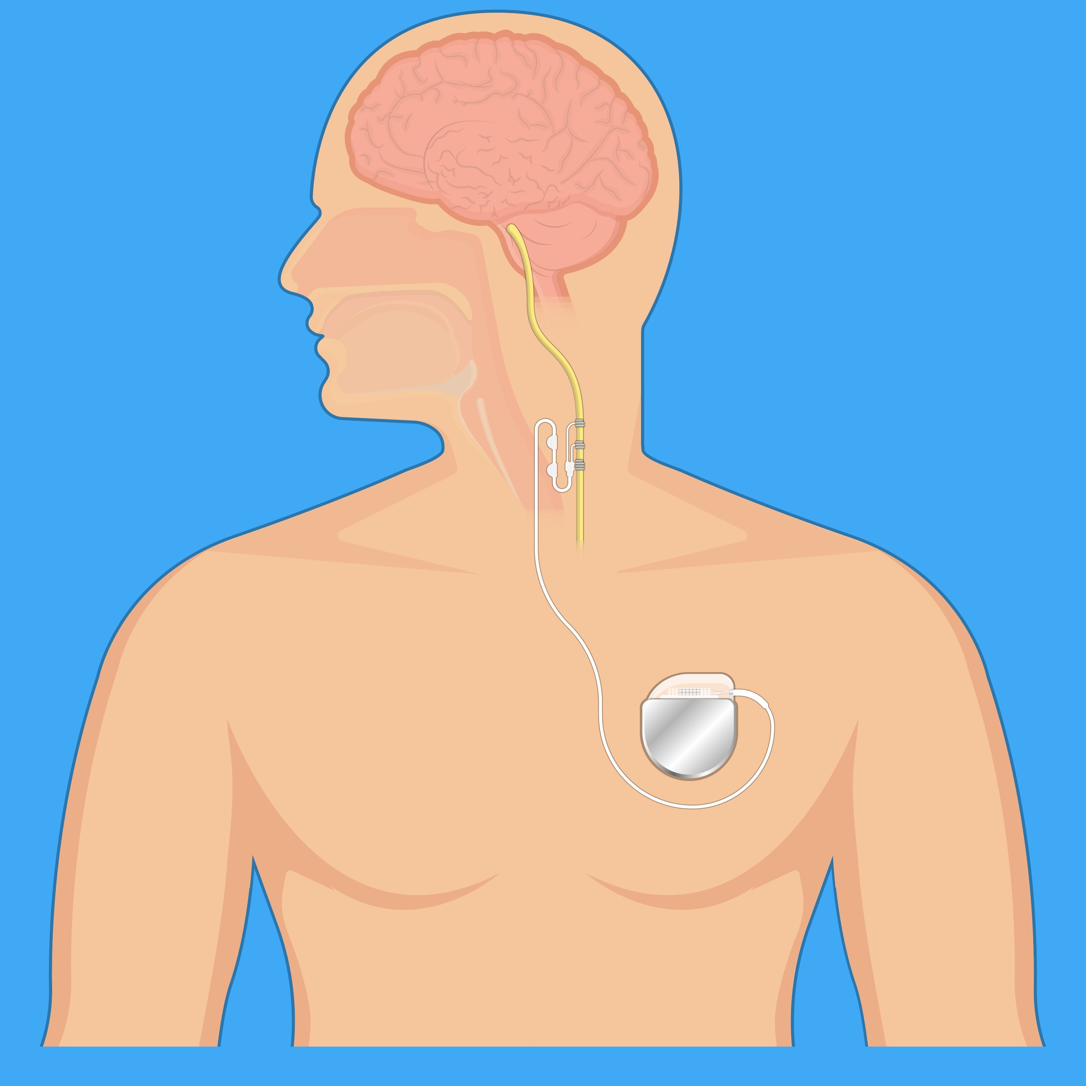 Vagus nerve stimulation device stimulate electrical impulse implantable stimulator treat epilepsy depression electroconvulsive therapy