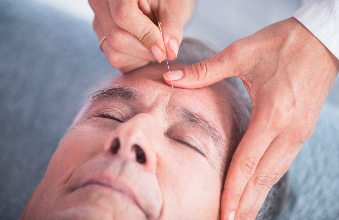 Treating migraine with acupuncture